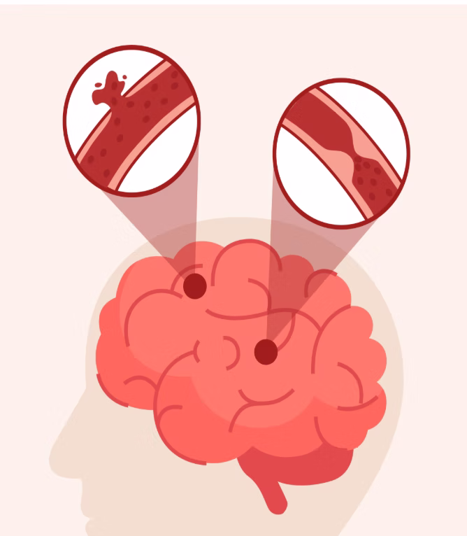How can the event of a stroke impact respiratory function?